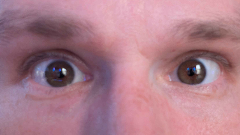 I got LASIK surgery